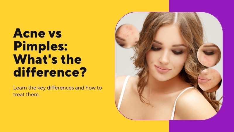 What's the Difference Between Acne and Pimples?
