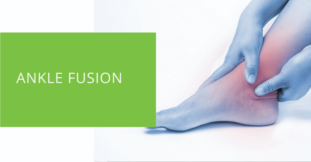 Understanding Ankle Fusion: A Guide to Arthrodesis Surgery