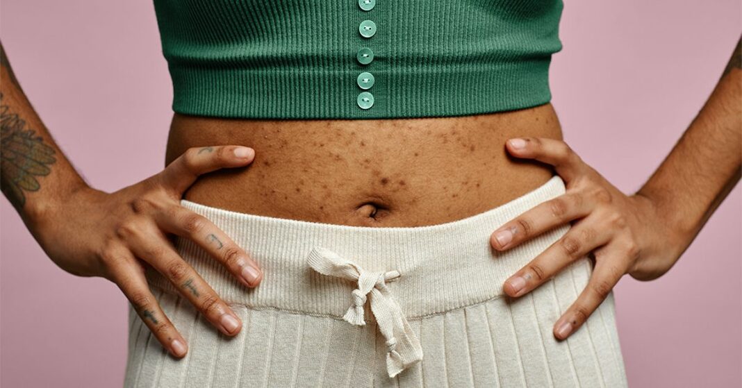 Why Do Belly Buttons Smell? Causes and Treatments