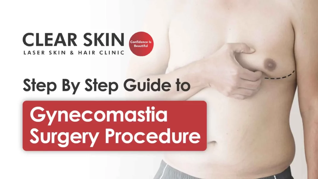 Step-by-step guide to Gynecomastia surgery procedure