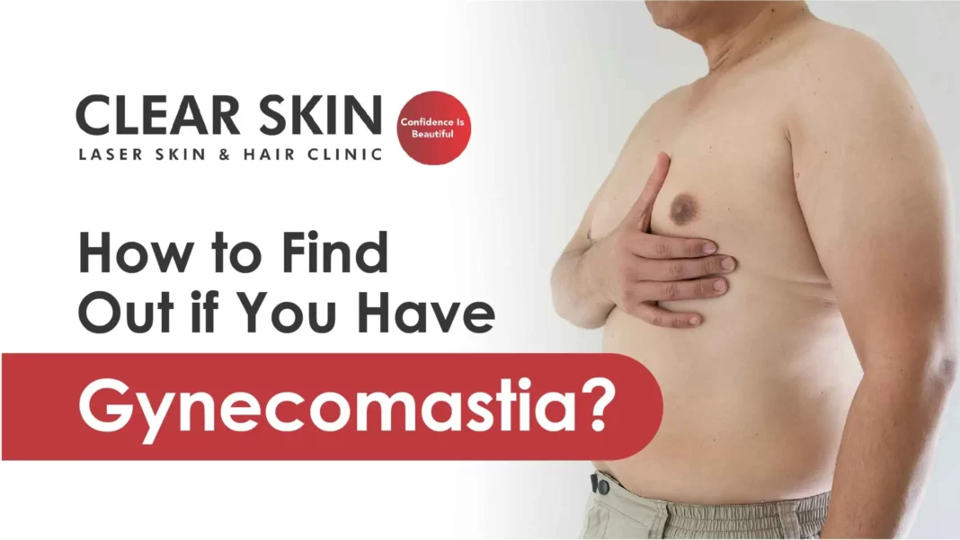How to Find Out if You Have Gynecomastia?