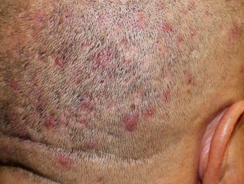 What Is Fungal Acne and How Do You Get Rid of It?