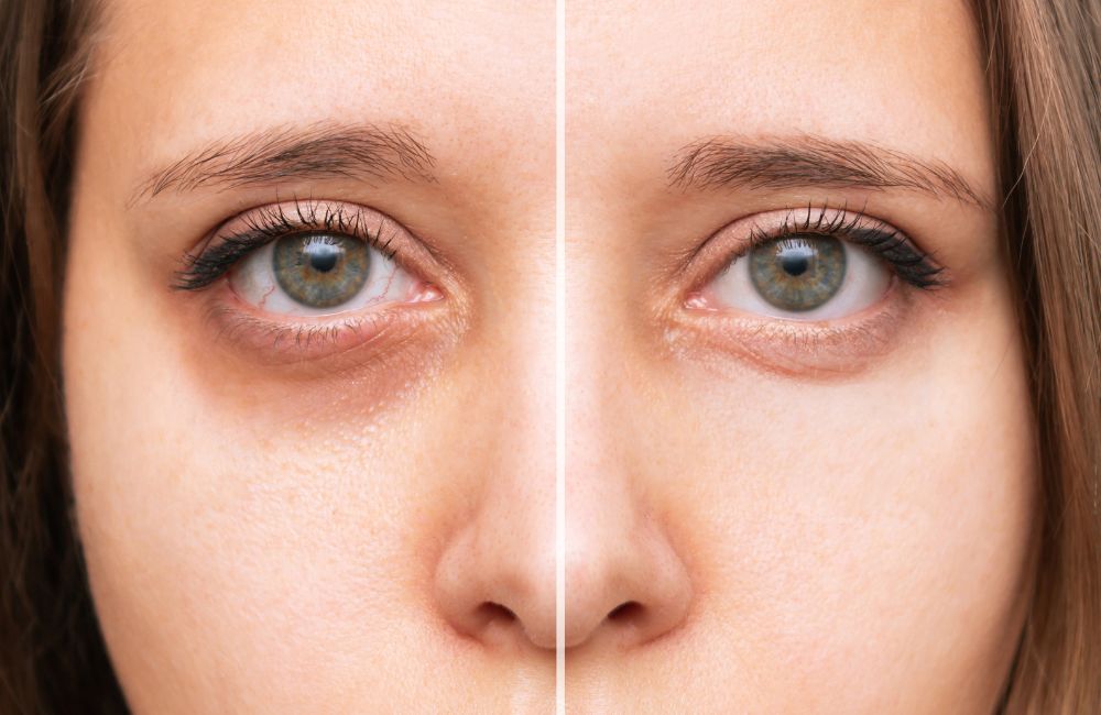Minimally Invasive Treatments for Dark Circles Under Eyes