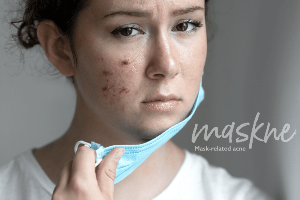 Maskne – The Sneaky Legacy of Covid-19 and How Wearing a Mask Causes Acne