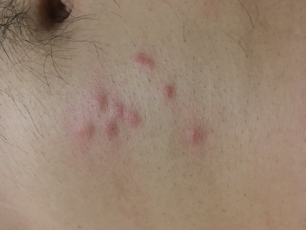 What Do Bed Bug Bites Look Like? (And What to Put on Them?)