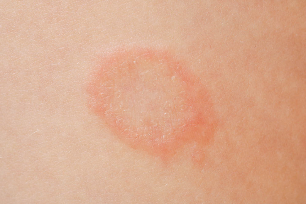 What Does Ringworm Look Like?